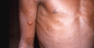 Foto: CDC/BRIAN W.J. MAHY/Agência Brasil
